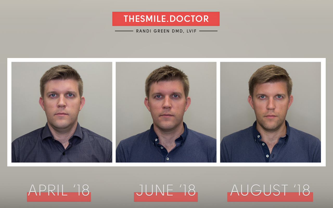 FAGGA UPDATE AUGUST 2018: Four months with my FAGGA (fixed anterior growth guidance appliance) growth appliance treatment and I am noticing profound changes in my face with upper jaw development. My mid-face is developing and I can breath through both nostrils for the first time which has led to a healthier existence that allows me to sleep much better at night.