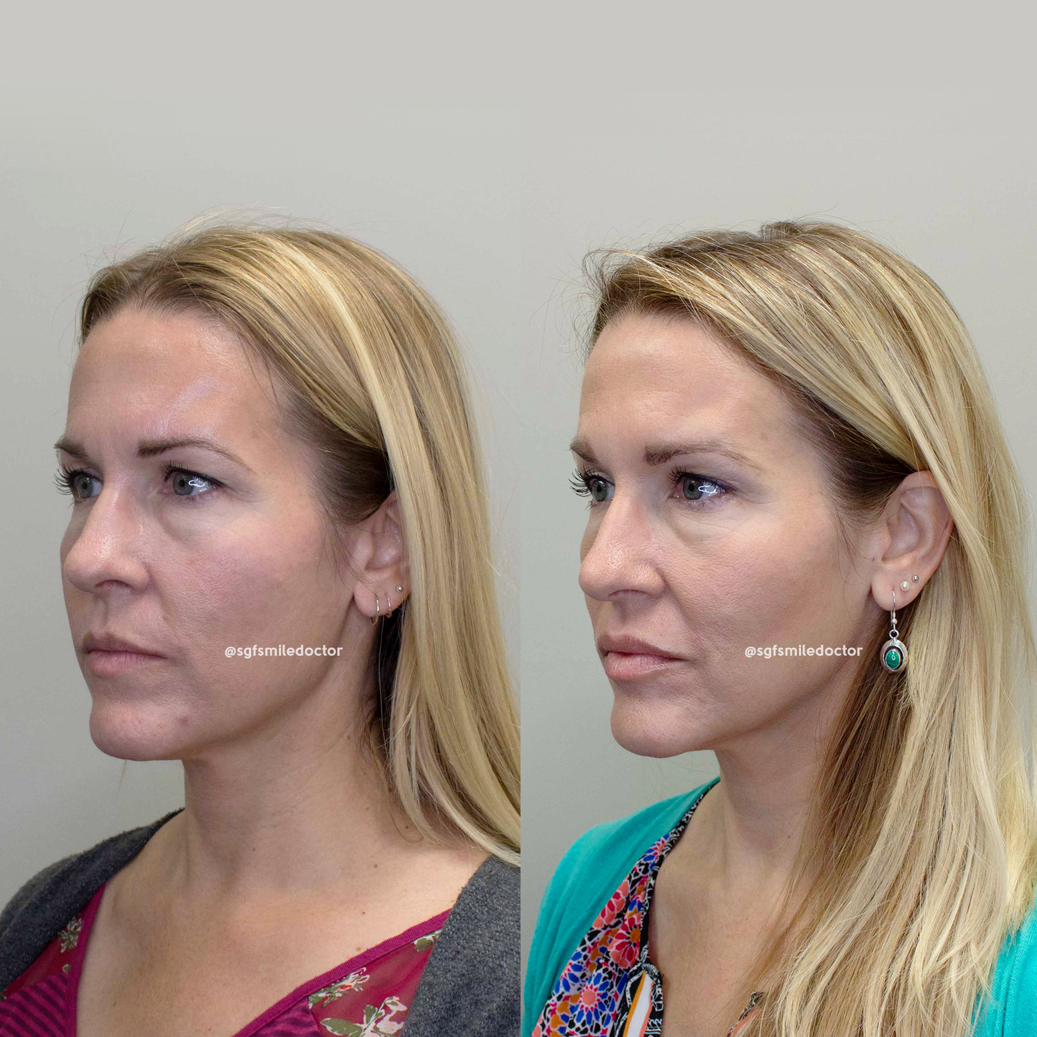AGGA Facial Development: Before / After