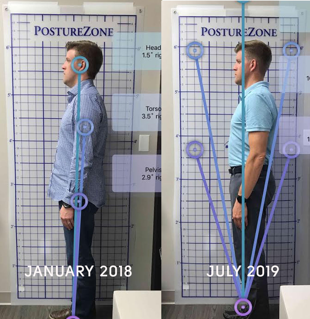 AGGA treatment full body profile image showing improved jawline and posture