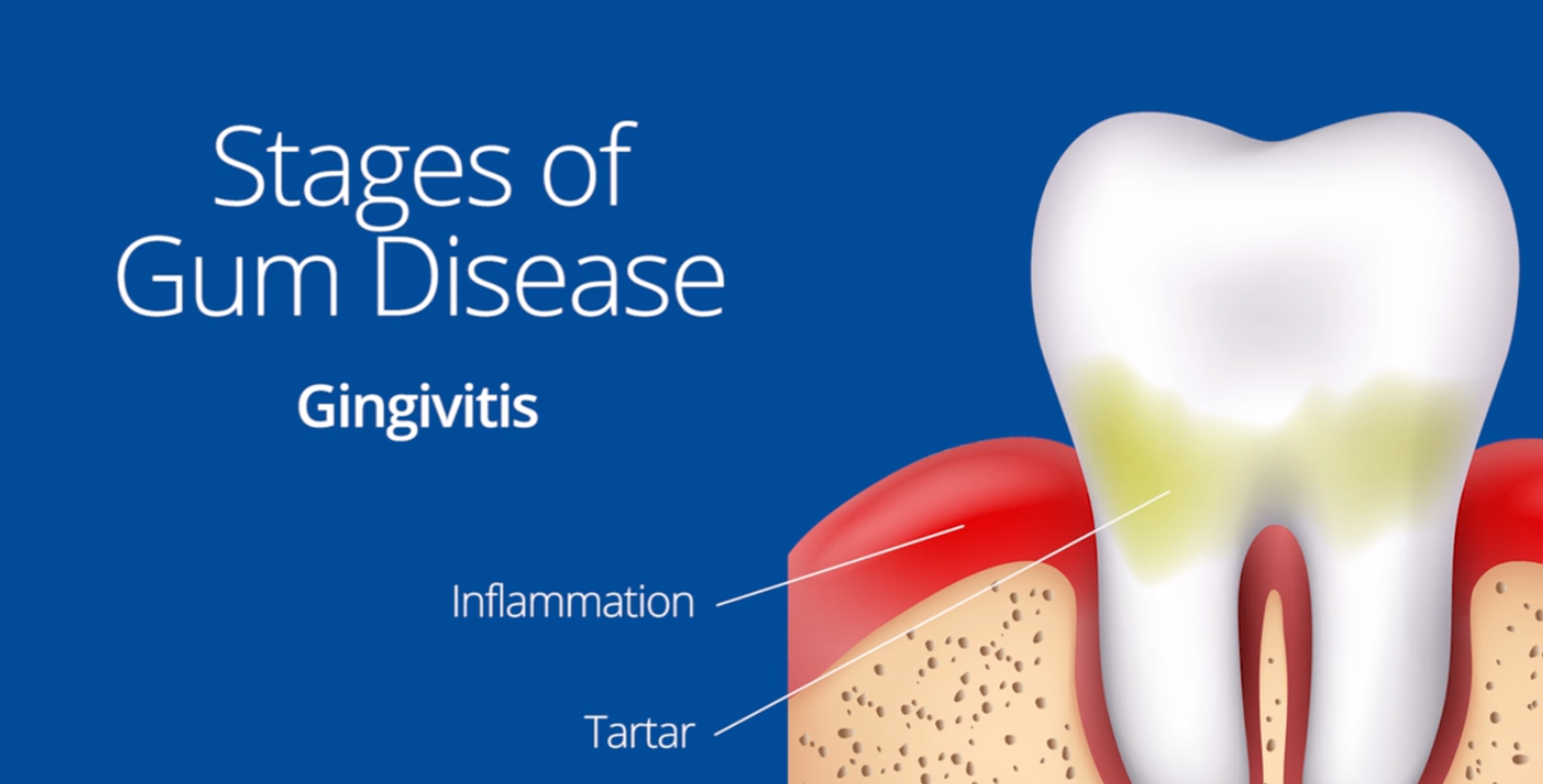 Can kissing my partner with bleeding gums spread gum disease