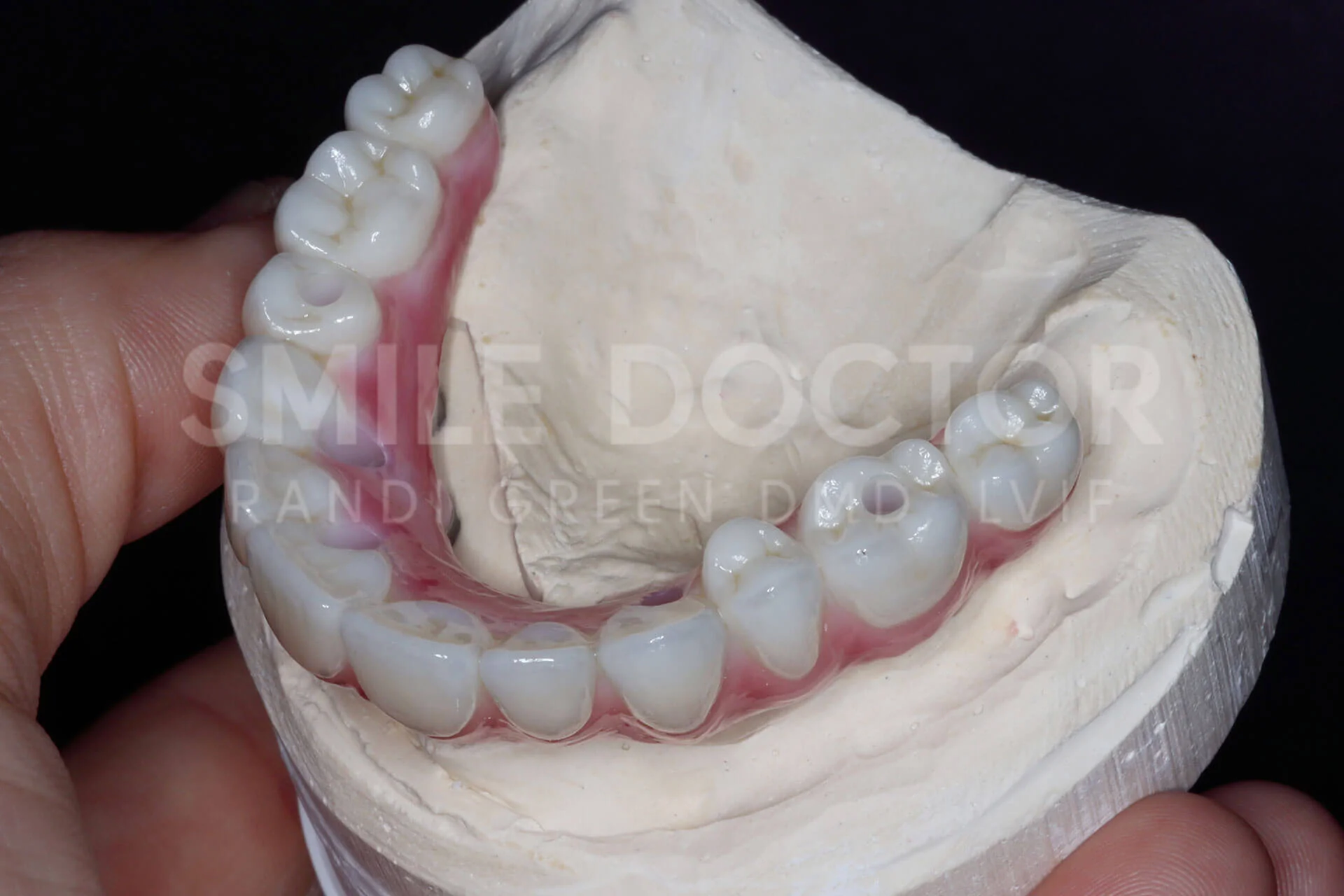 Implant Supported Dentures — Springfield Smile Doctor