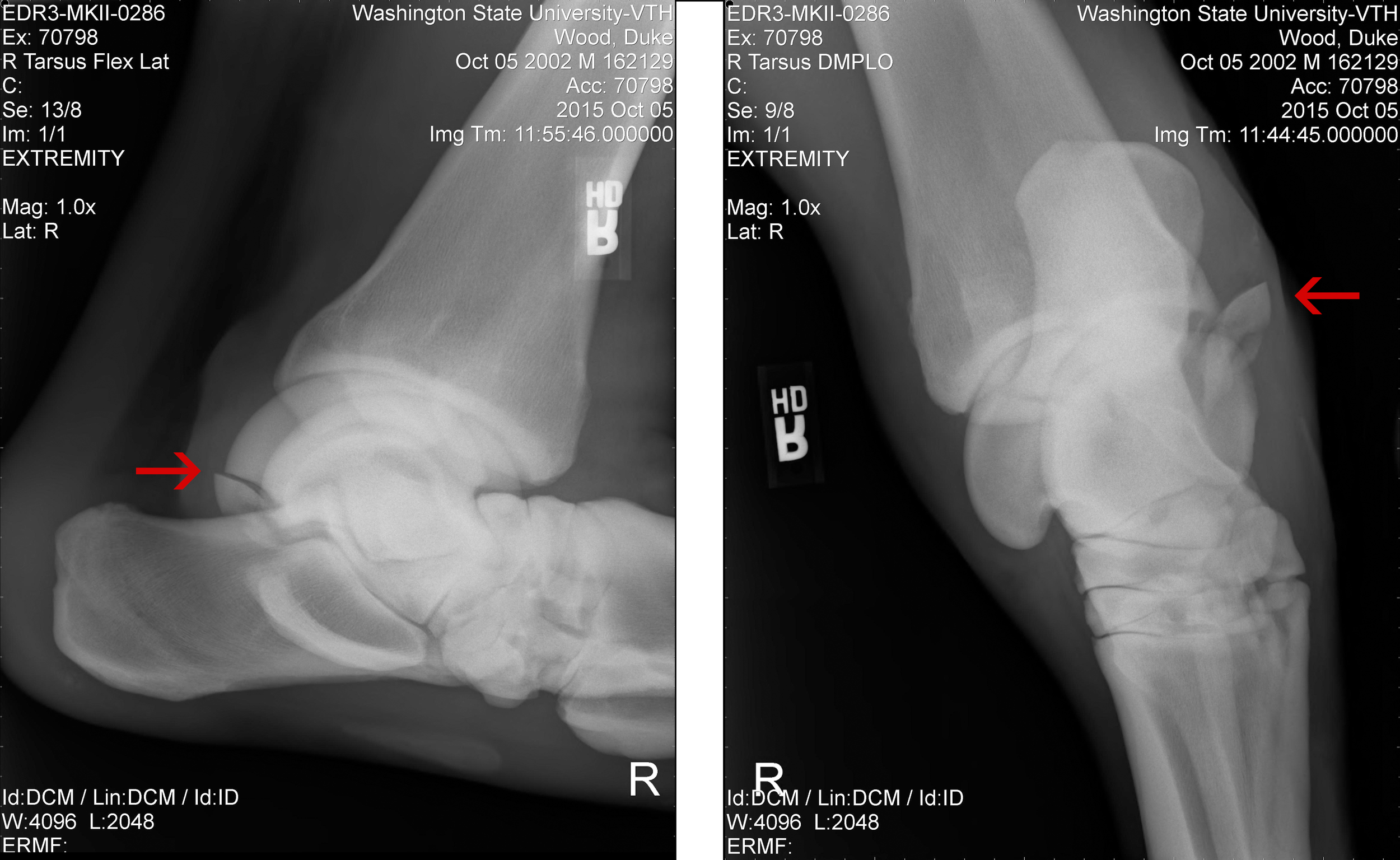 On extension of the limb, the chip was pushed out of the joint area which probably helped prevent further damage to the cartilage and soft tissues in the joint.