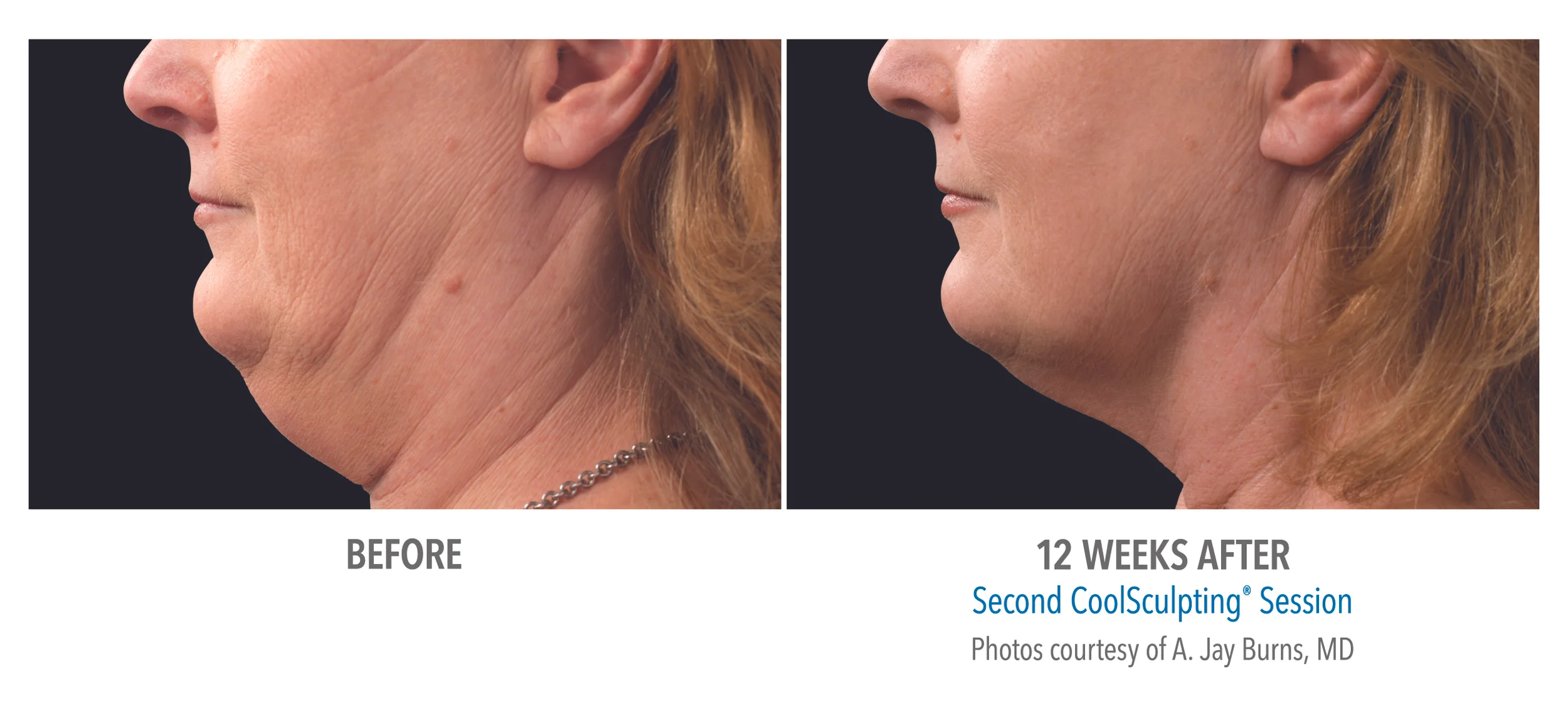B&A-Burns-SM-pt012F-2set-18wk2_LEFT.jpg