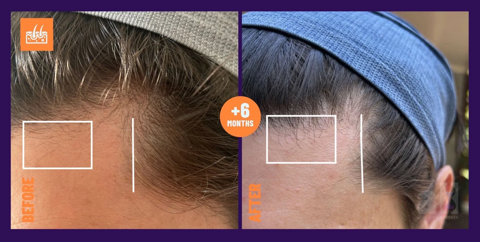 OneSkin Hair Serum Review Before and After Left-Side with callouts on areas of improvement on the left side of the head