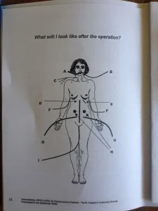 Peritonectomy surgery, the black line is the incision