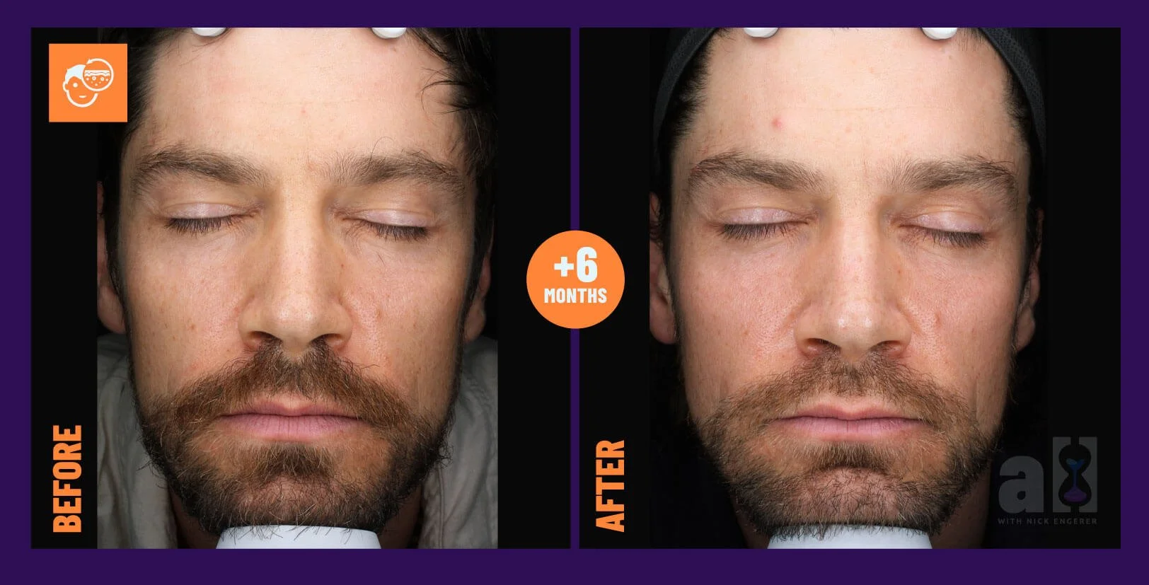 Young Goose Skincare Review - Before and After 6 Months - Front of Face Only