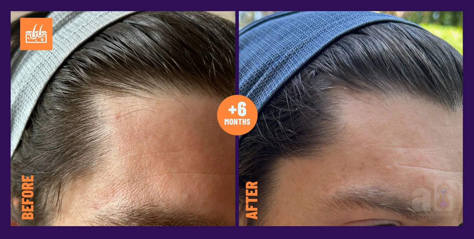 Oneskin OS-01 hair serum review - right side angle side 2 with before and after improvements with 6 months of consistent use