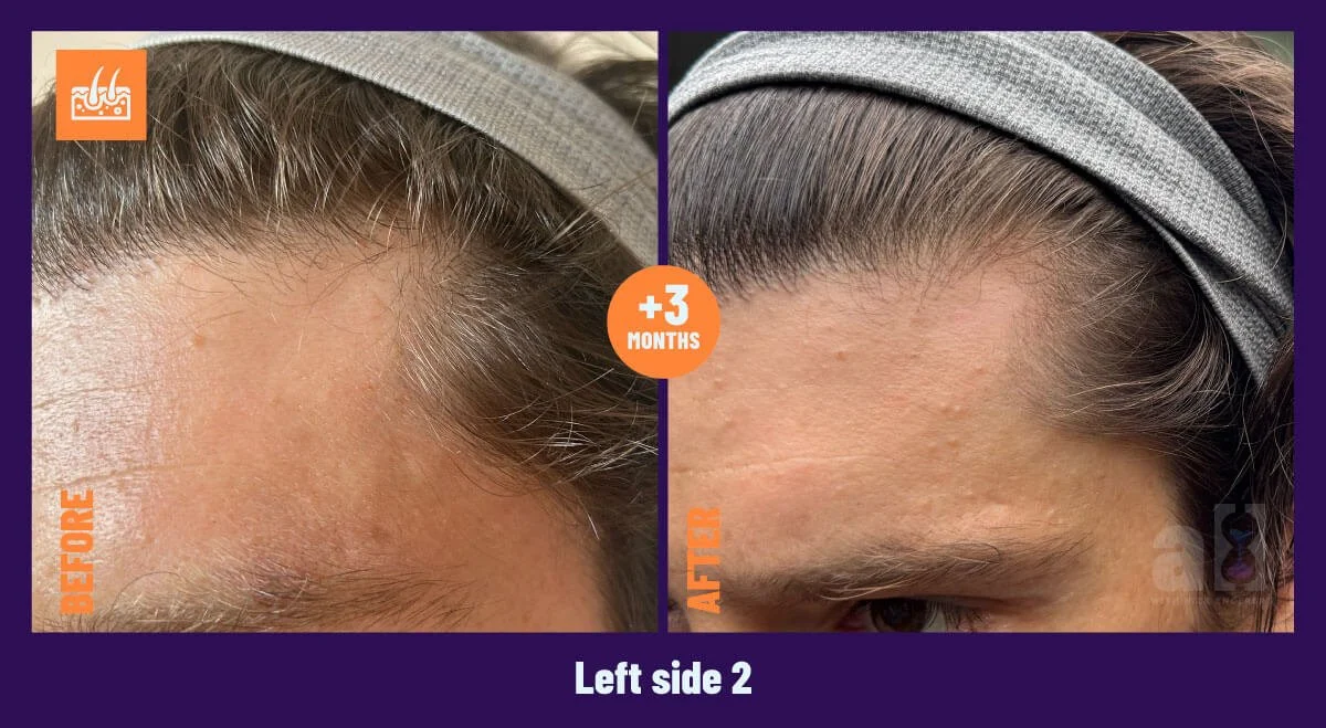 One Skin hair serum review OS-01 peptide showing another angle of the left side of the head after 3 months