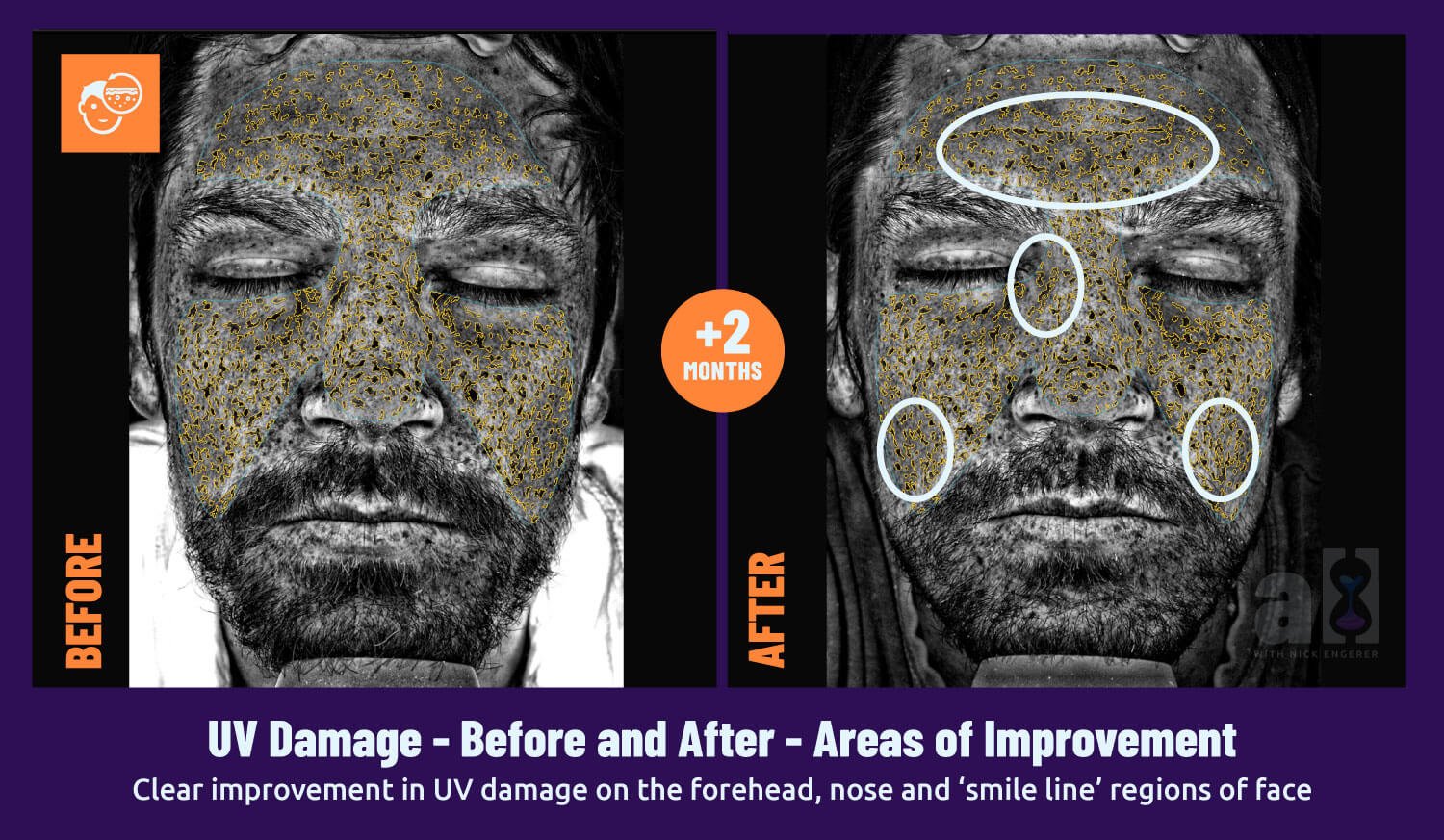 Young Goose Skincare review-before-after-uv-damage-reversal-forehead-nose improvements with 2 months of continuous use