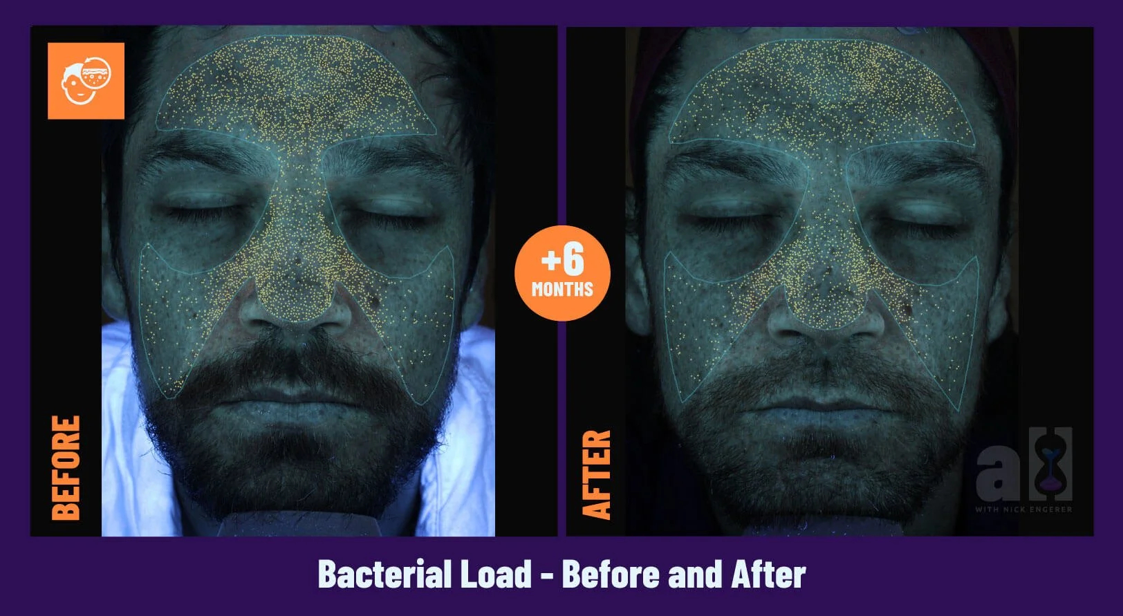 Young Goose Skincare Review - Before and After 6 Months - Front - Bacterial Load - improvement from 46th to 68th percentile