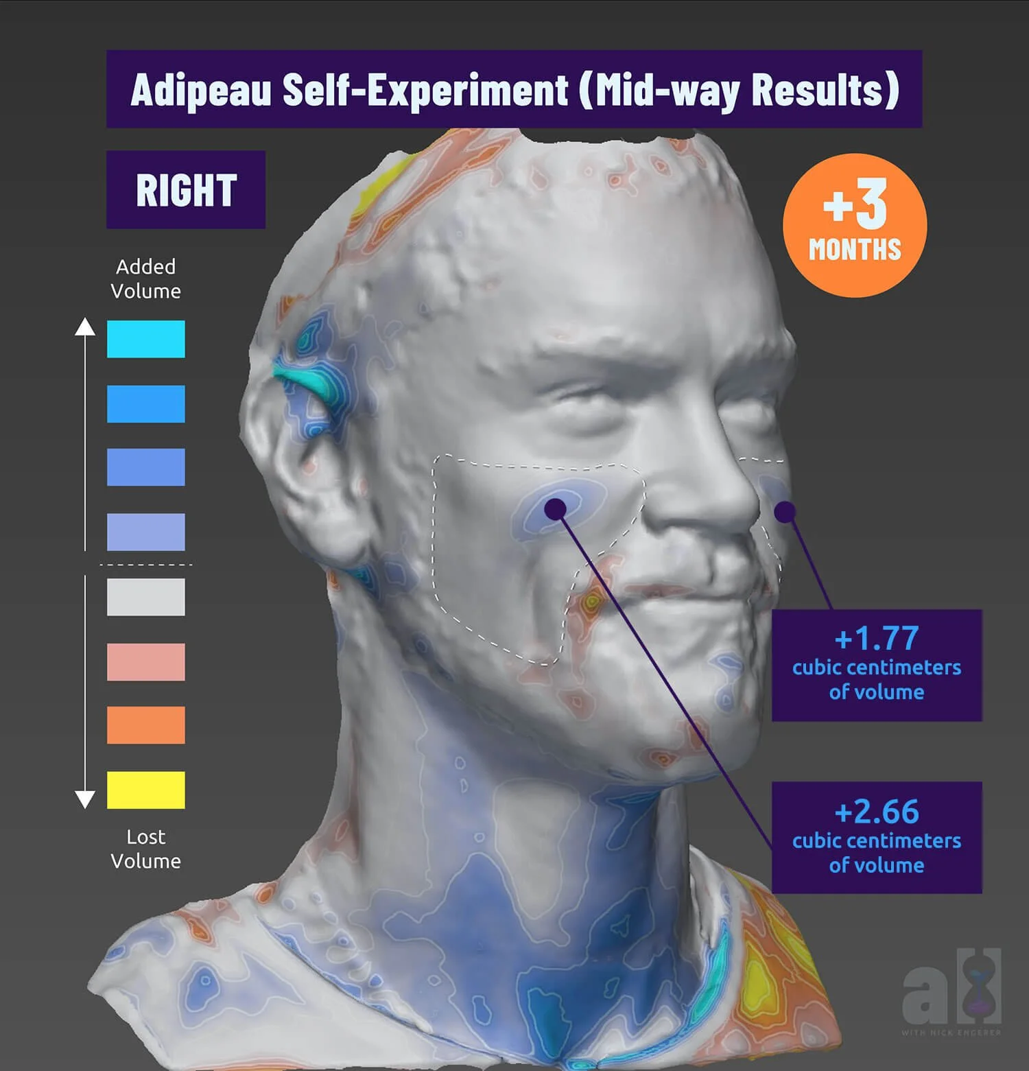 Adipeau before and after image - right side of face volume improvement