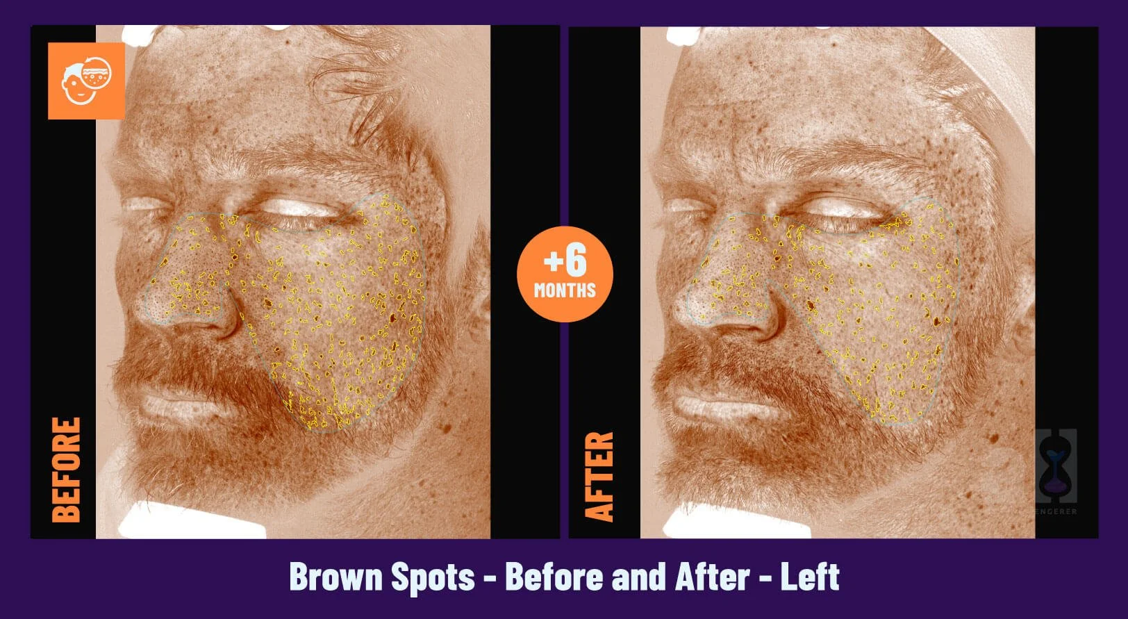 Young Goose Skincare Review - Before and After 6 Months - Left - Brown Spots on Nick's left side of face