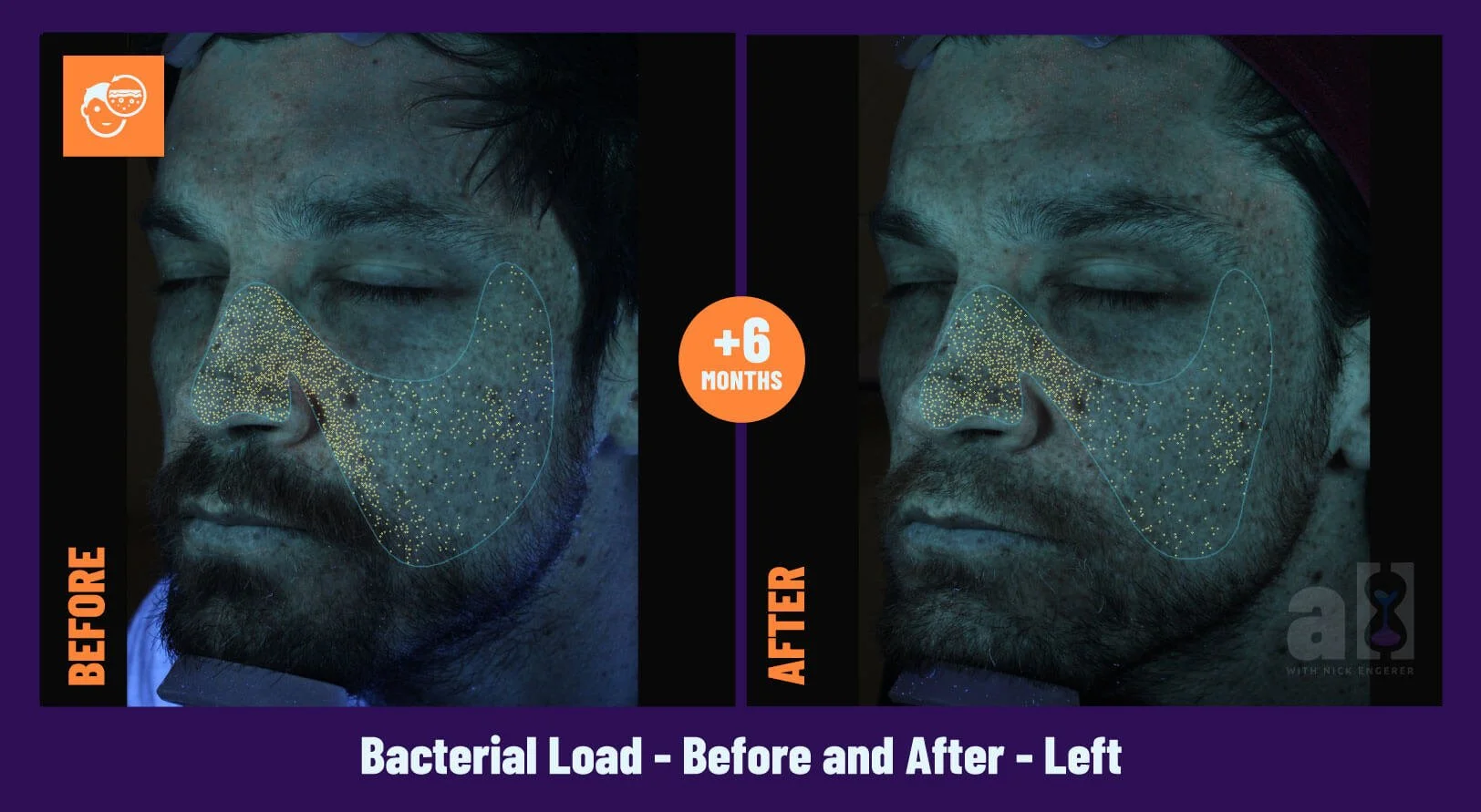 Young Goose Skincare Review - Before and After 6 Months - Left - Bacterial Load - improvement from 72nd to 82nd percentile