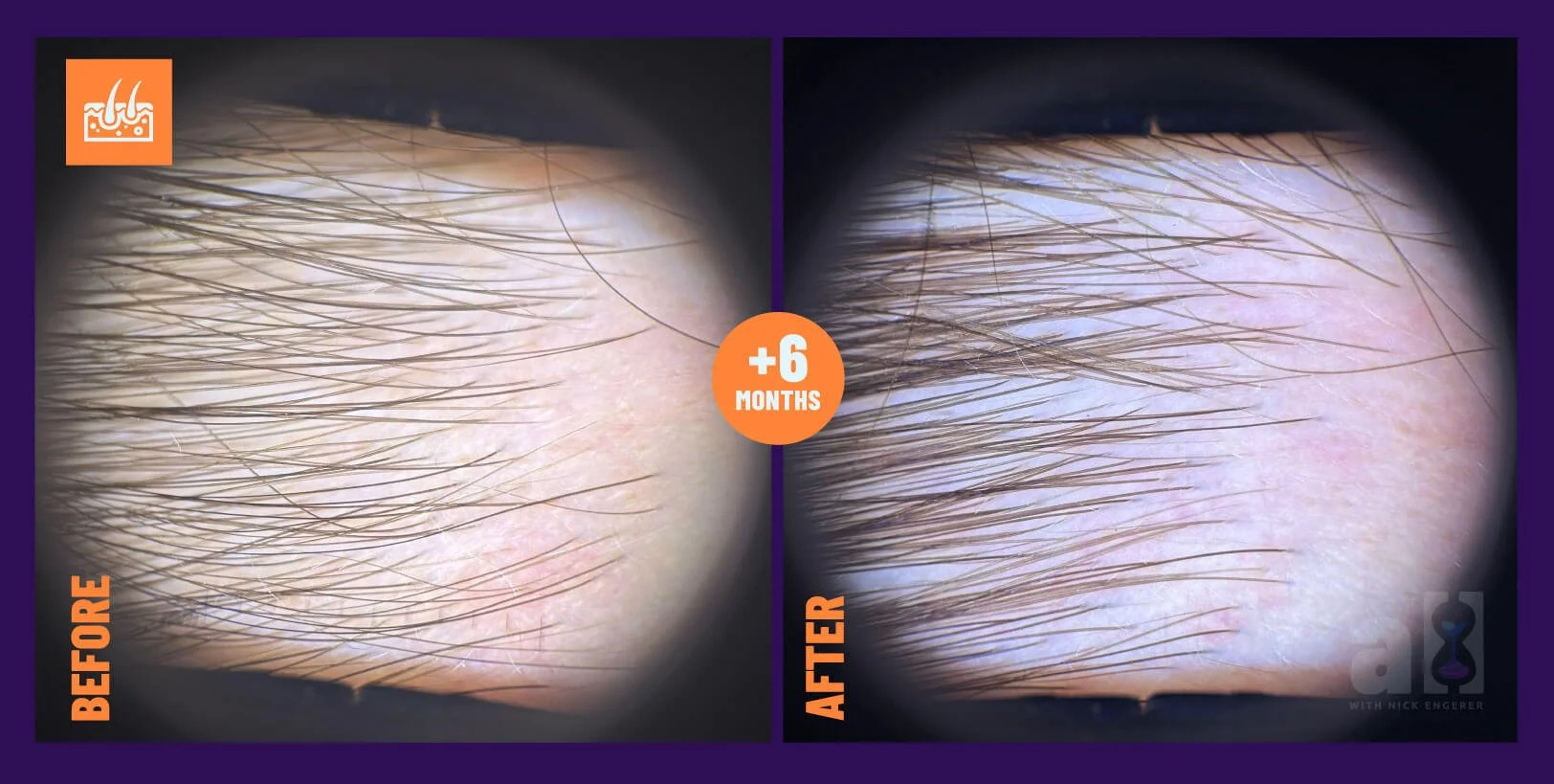 oneskin hair serum review OS-01 after 6 months - right side zoomed angle side 2 with microscopic view