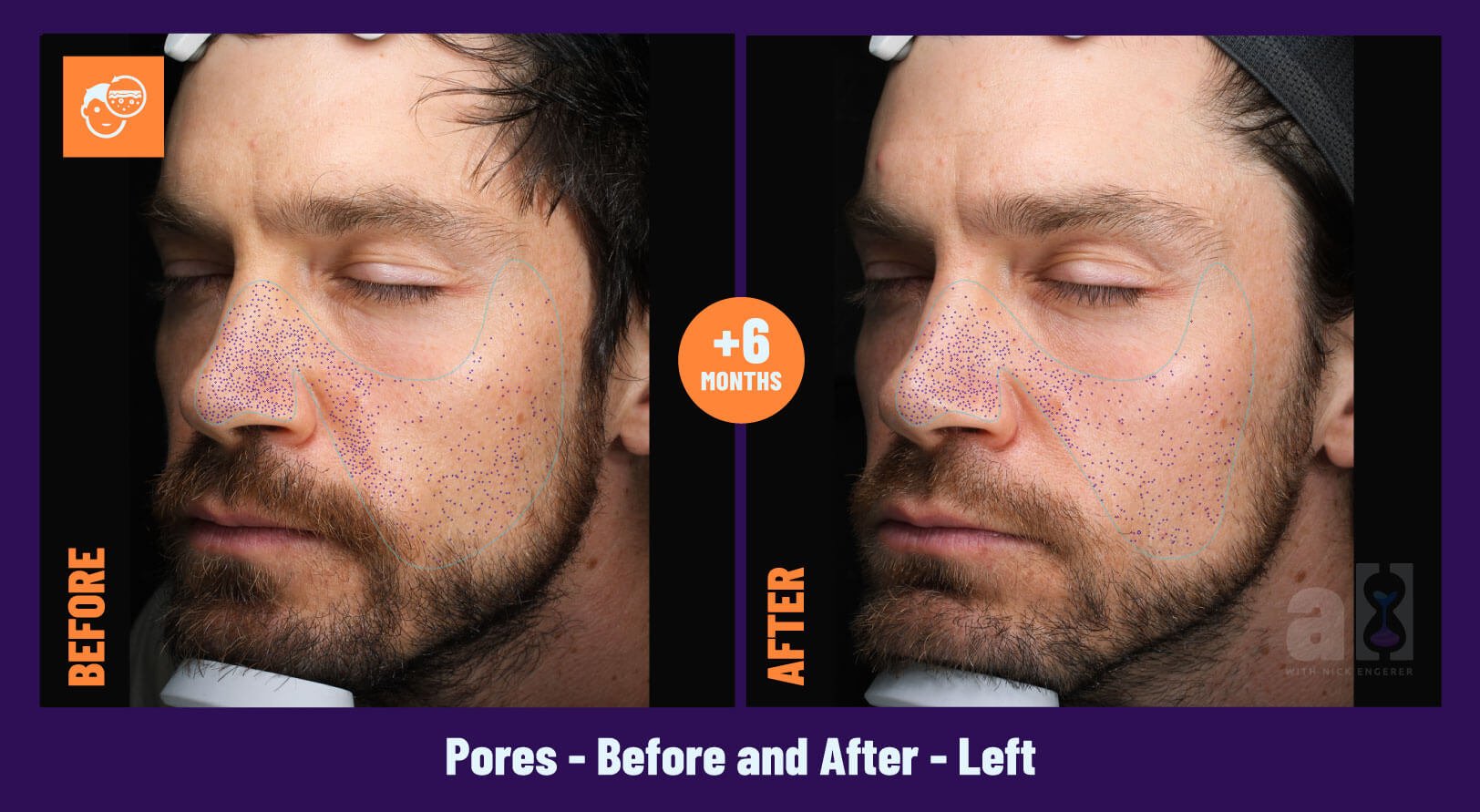 Young Goose Skincare Review - Before and After 6 Months - Left - Pores - there is an improvement from 22nd to 35th percentile