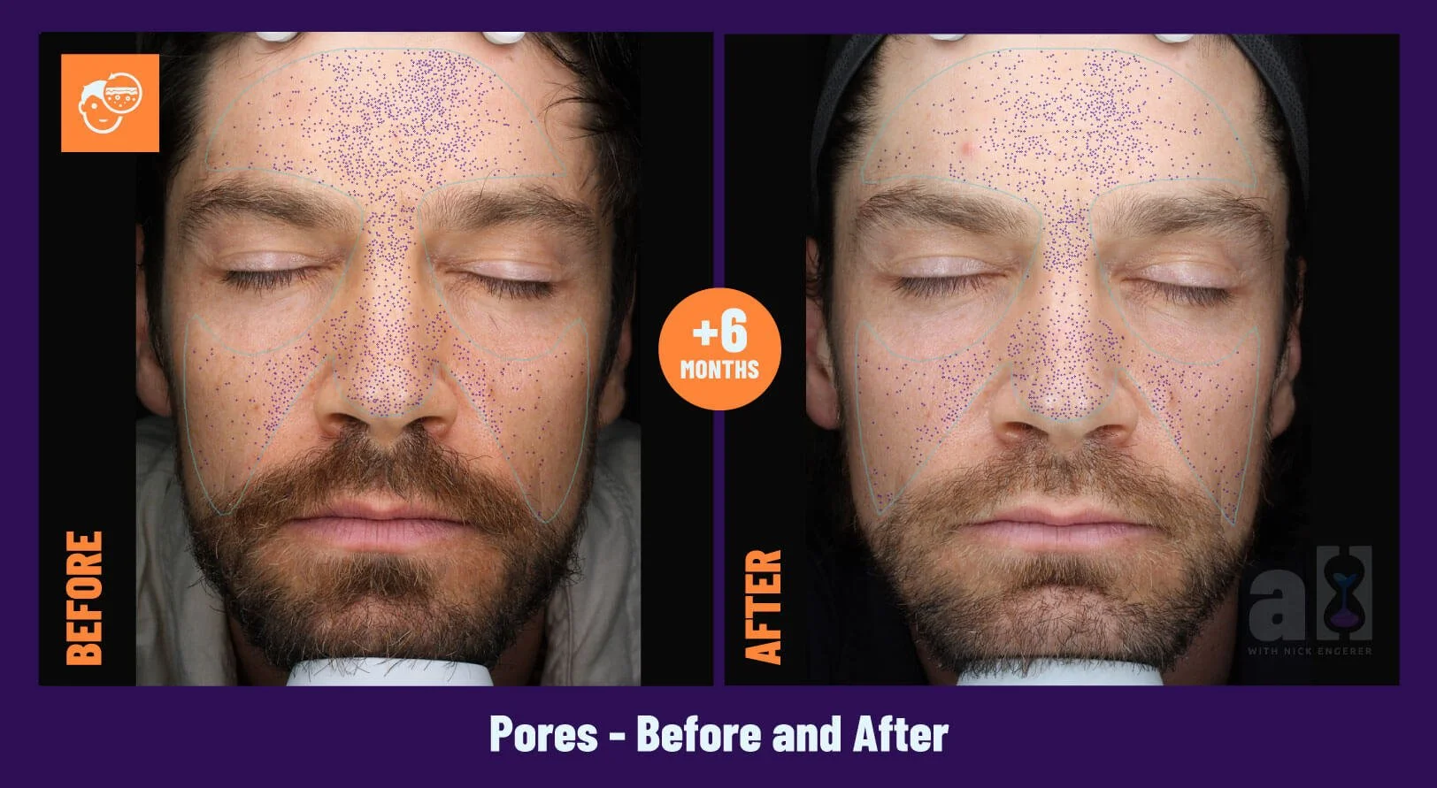 Young Goose Skincare Review - Before and After 6 Months - Front - Pores - there is an improvement from 16th to 37th percentile after 6 months