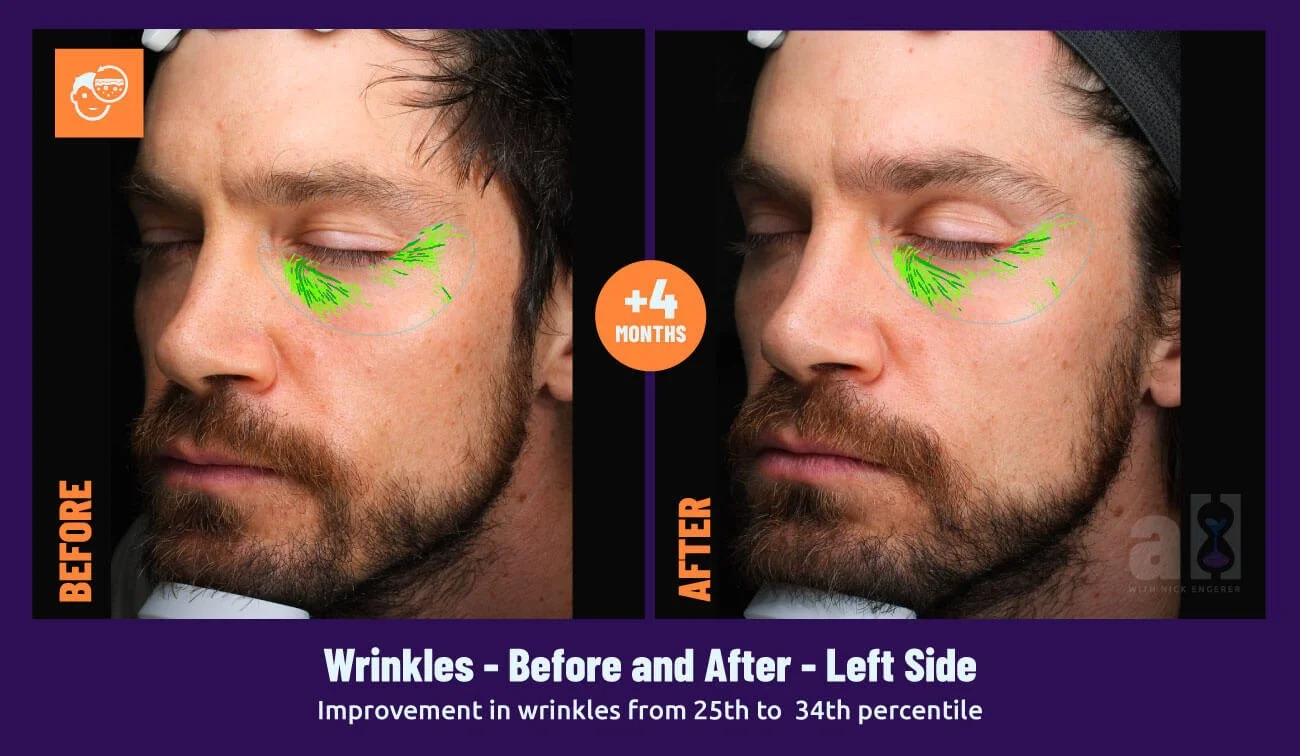 Young Goose Review left side wrinkles face scans - after 4 months of skincare use there is an improvement