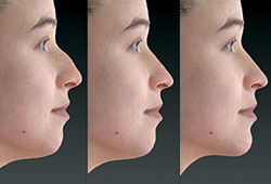Changes in facial profile.