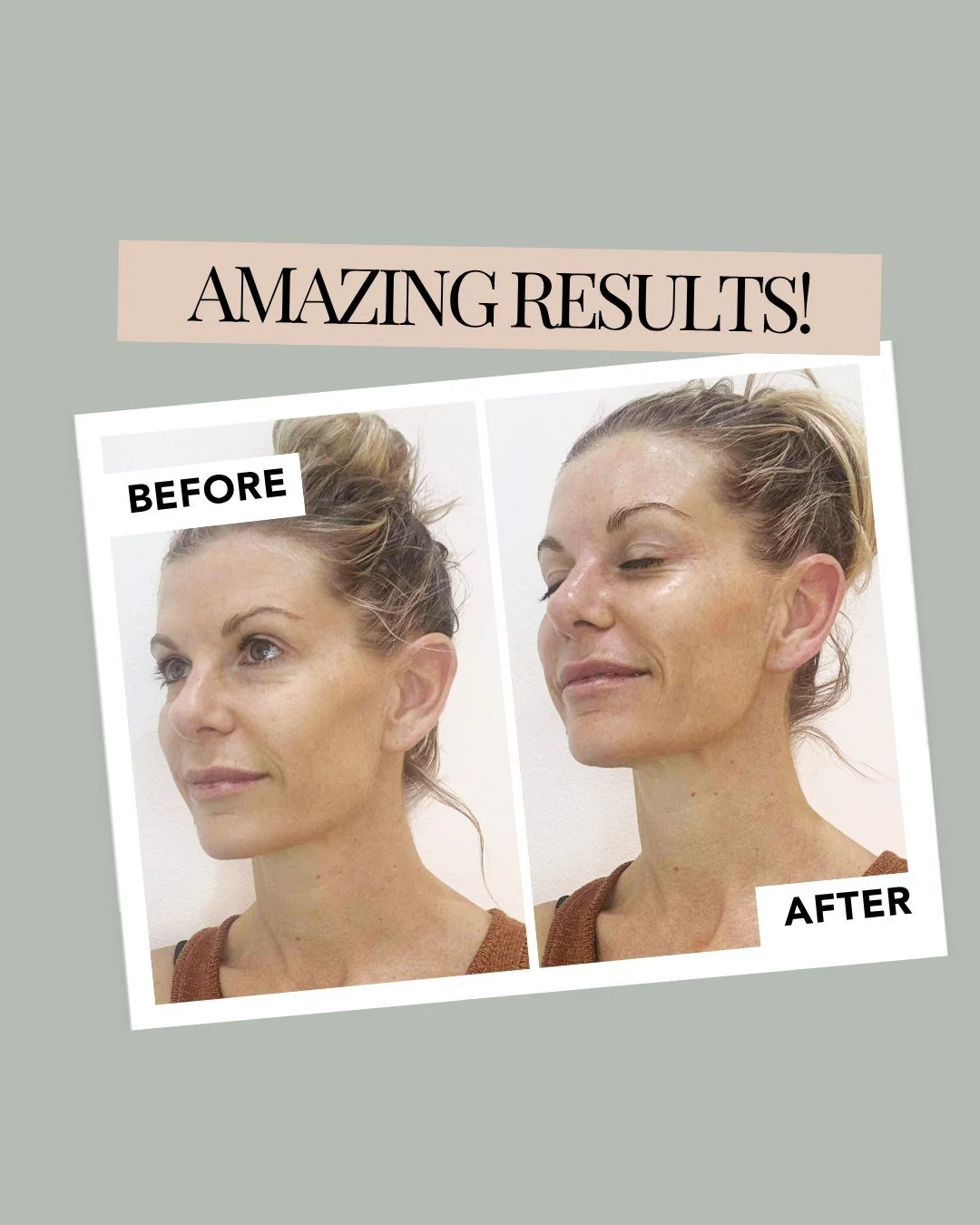 Before &amp; After

Nothing speaks louder than results 💫
See the transformation our Carbon Laser Facial can achieve - refined pores, brighter tone, and smoother texture after just one treatment.

✨ Book your glow today: http://phore.st/r3wBk

#Carbo