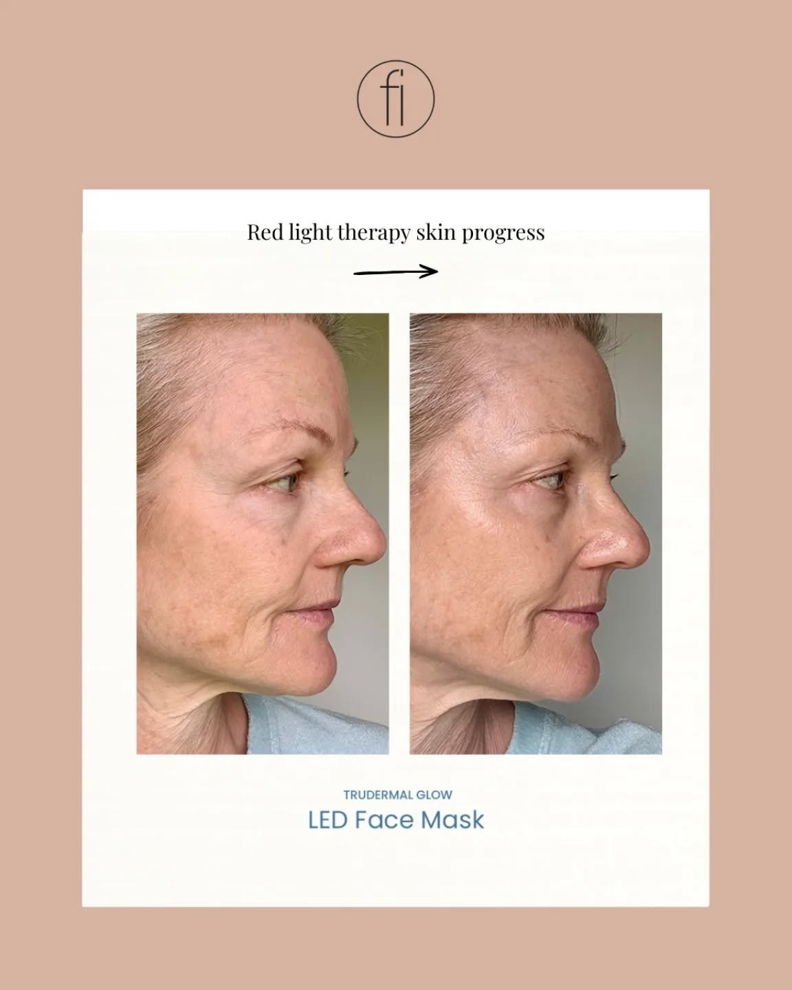 Supporting your skin health in a gentle, non invasive way ✨

Tru Dermal Red Light Therapy uses specific wavelengths of light that may assist in supporting the skin&rsquo;s natural processes. This treatment may help improve the appearance of overall s