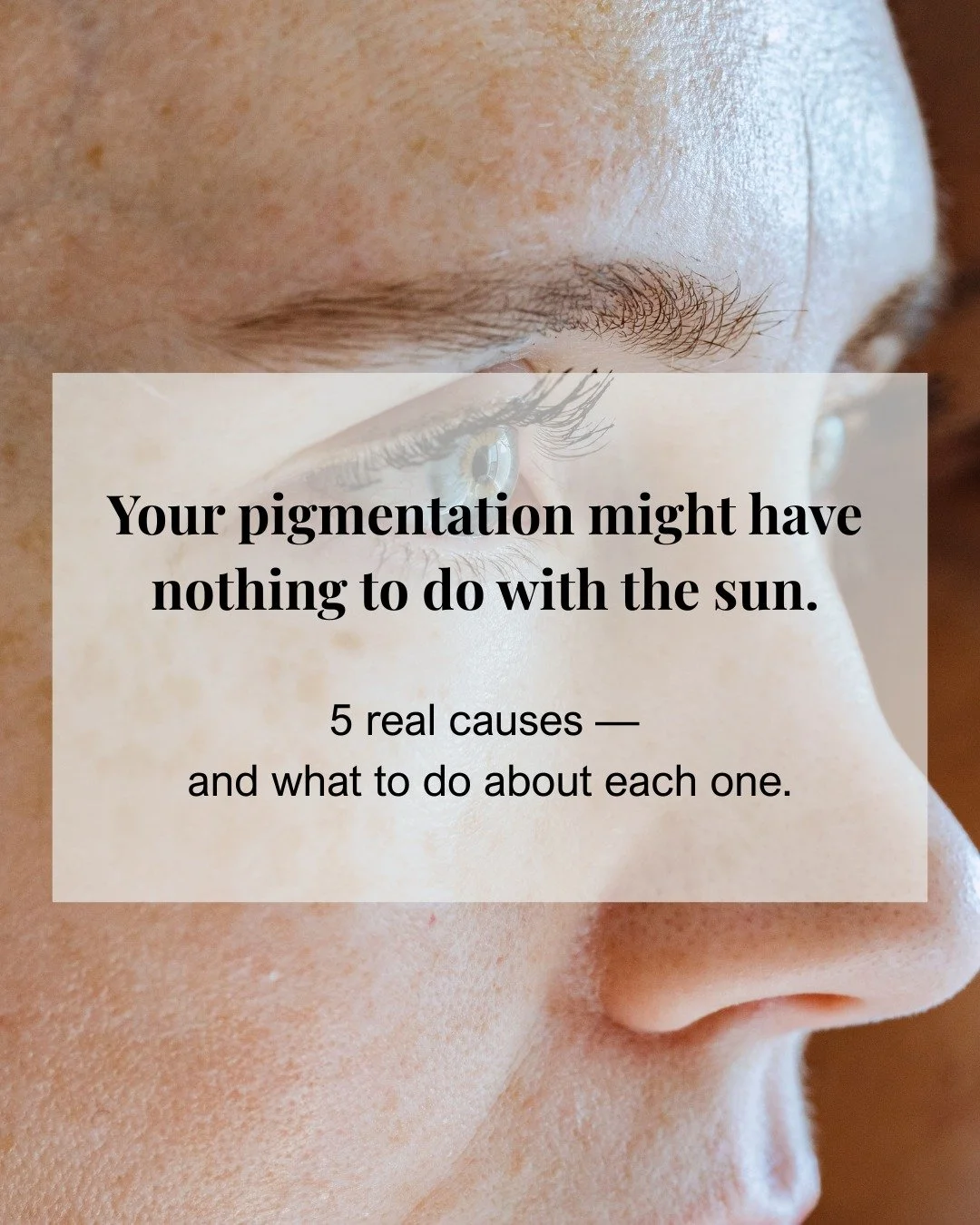 Your pigmentation might have nothing to do with the sun.
Most women spend years trying to fade dark spots with the wrong products &mdash; because no one told them what actually caused them in the first place.
Swipe through to see the 5 real reasons p