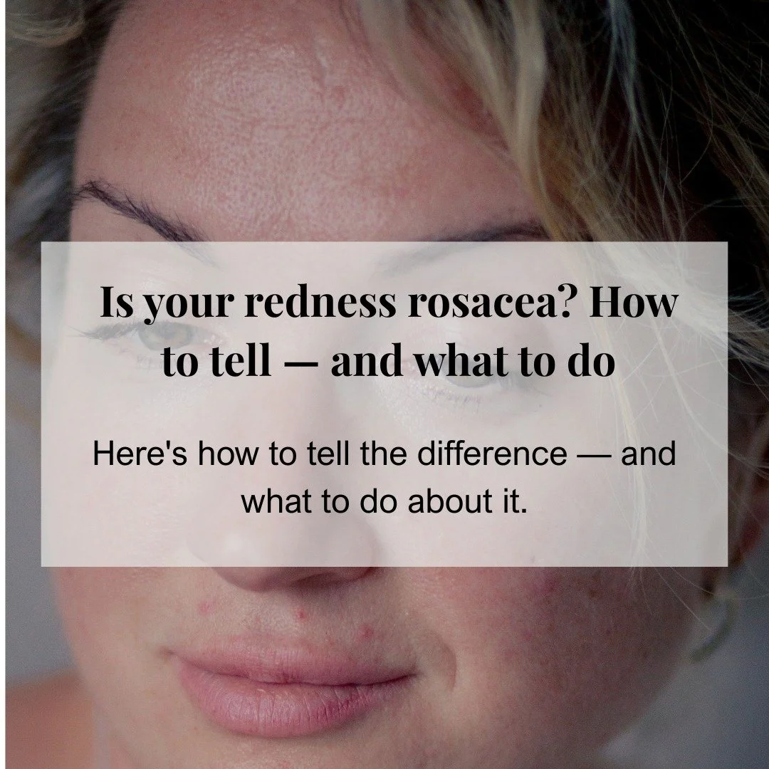 Not all redness is rosacea. But if yours keeps coming back &mdash; it's worth knowing the difference.

Rosacea affects 1 in 10 women and is one of the most mismanaged skin conditions we see at the clinic. Mostly because it gets treated like sensitivi