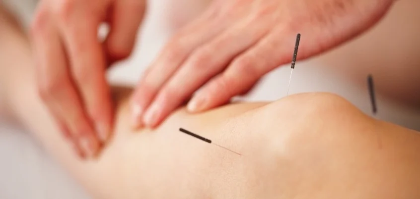 acupuncture-e1349916447299.jpg