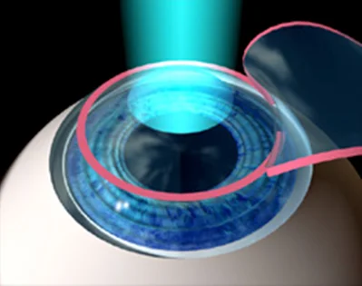Lasik.jpg