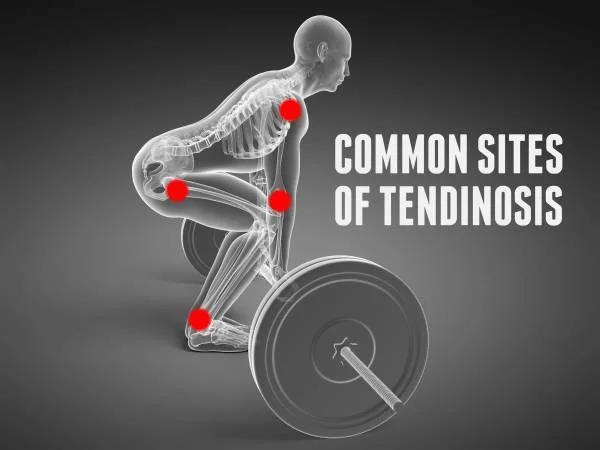 tendinosis.jpg