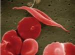 Sickled red blood cell Source: NIH