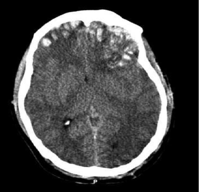 CT scan showing brain injury, including hemorrhage, contusions, Source: Rehman T, et al