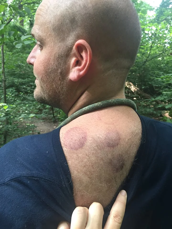 I received some cupping for an achy back and neck! it helped so much! these are the marks left - they will dissapear in couple days.