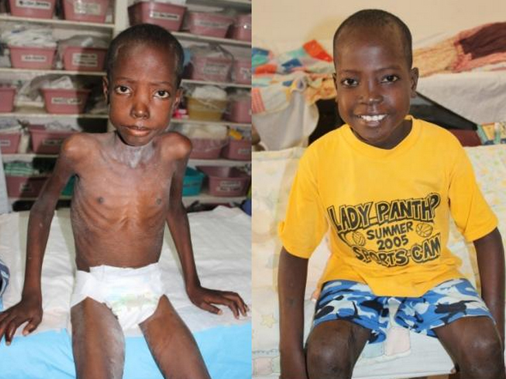 An example of the drastic improvement a child can have when receiving care from a malnutrition program providing plumpynut, vitamins, medical care, & love....in just 3-4 months!