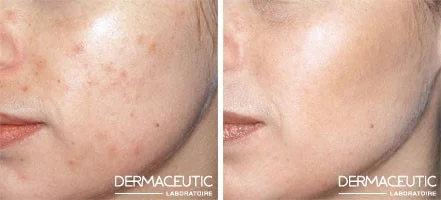 Dermaceutic MASK Peels