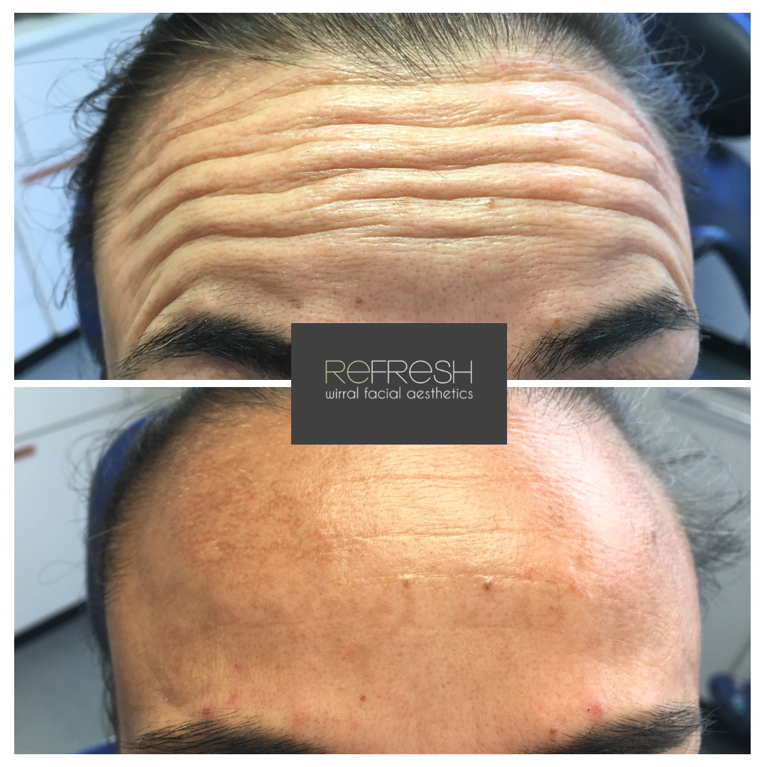 Botox for website.png