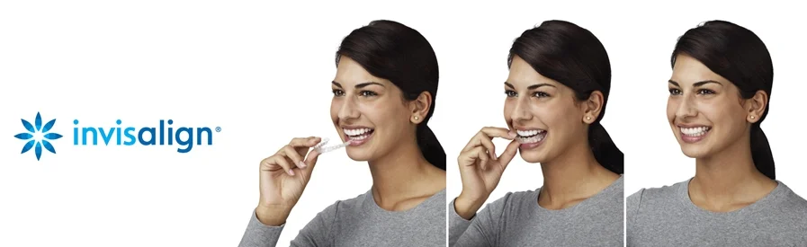Invisalign.jpg