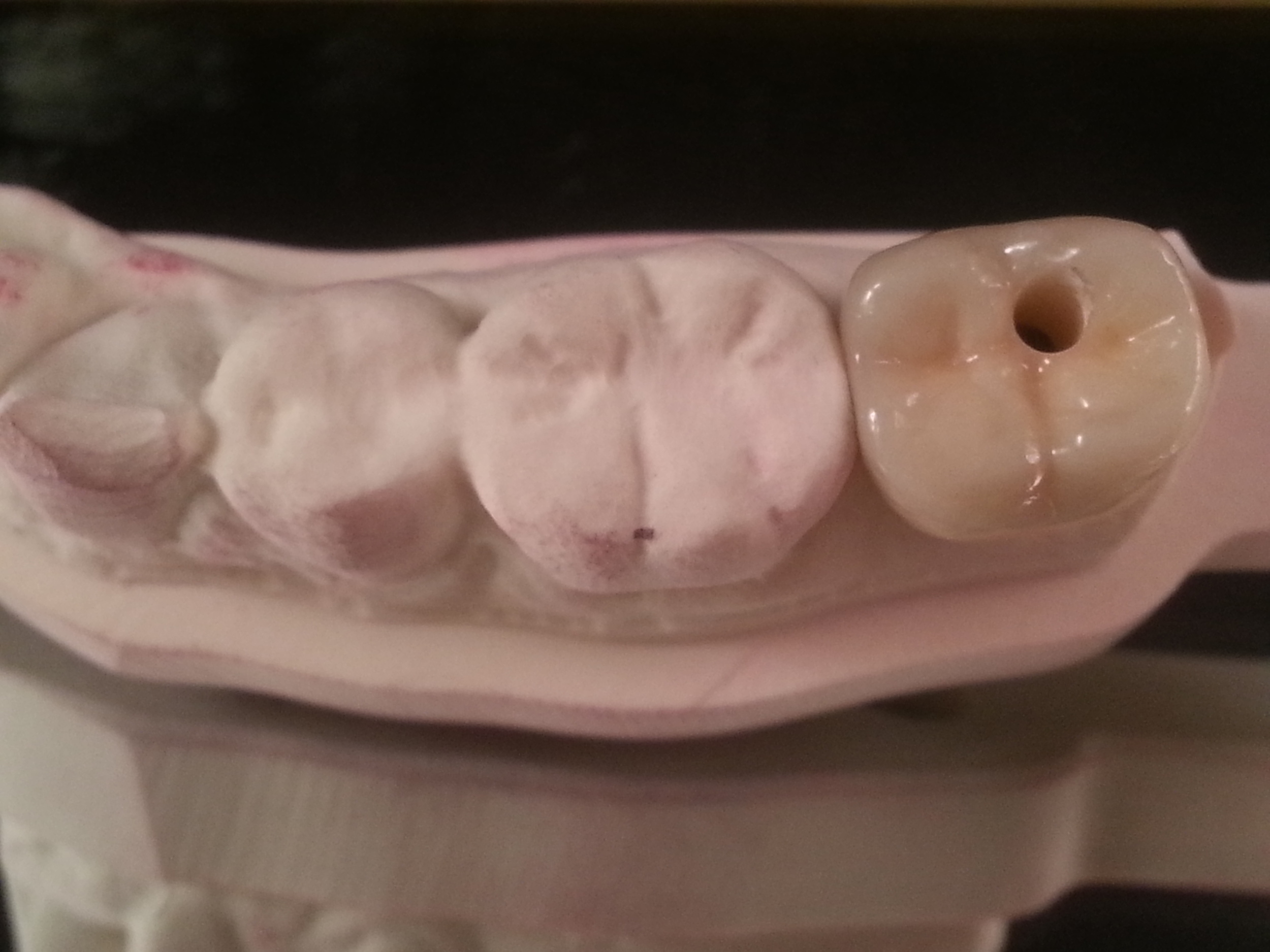 Multi Layered Zirconia old Rutherford Dental Lab