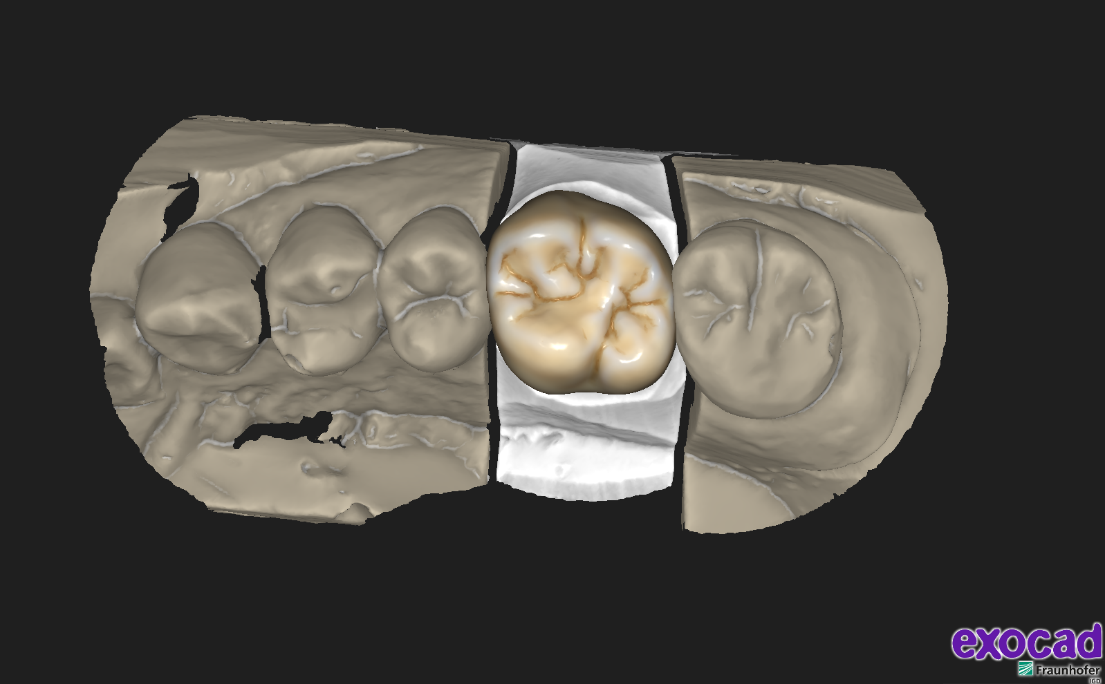 Multi Layered Zirconia old Rutherford Dental Lab