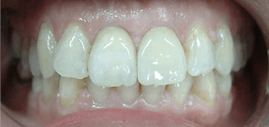 Fitted porcelain crown onto dental implant