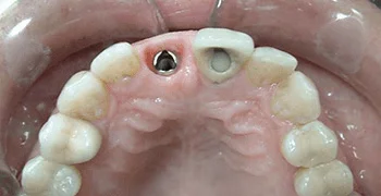 Single tooth implant 3 months after placement