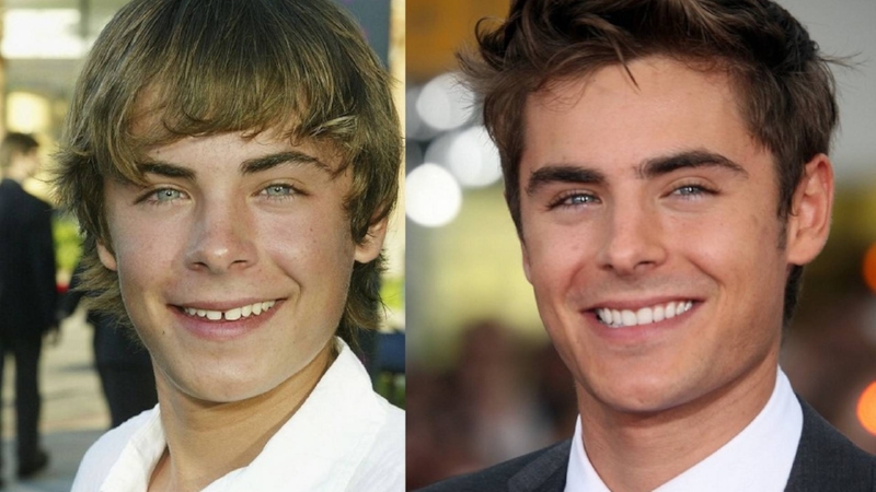 Zac Efron turned to Invisalign® to correct his diastema