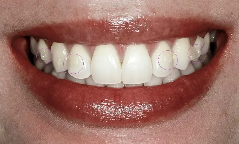 White composite buttons which are placed on your teeth to help move your teeth into the desired positon.