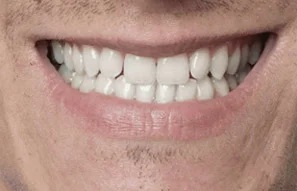 implant-dentures-3.jpg