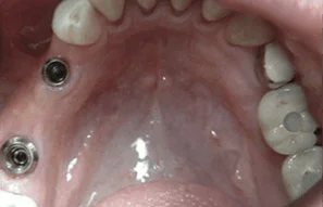 implant-dentures-1.jpg