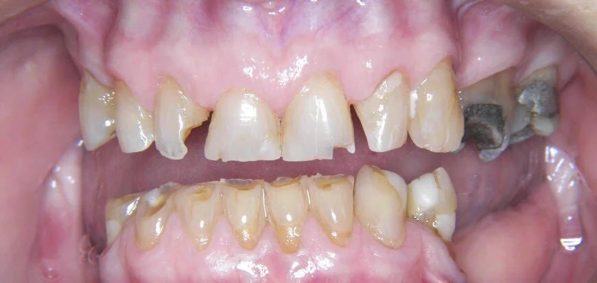 Wear and tear on front teeth of a patient missing rear teeth