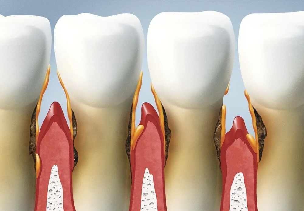 5 Ways to Prevent Gum Disease What Causes Gum Disease?
