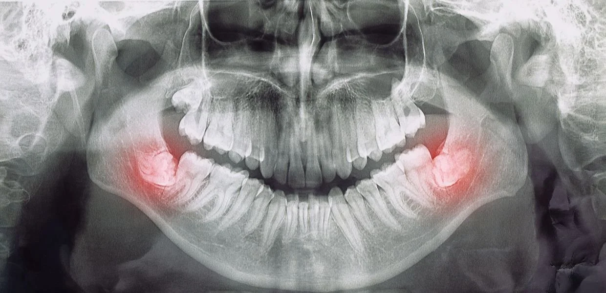 Wisdom Teeth Removal What You Need to Know CC Dental