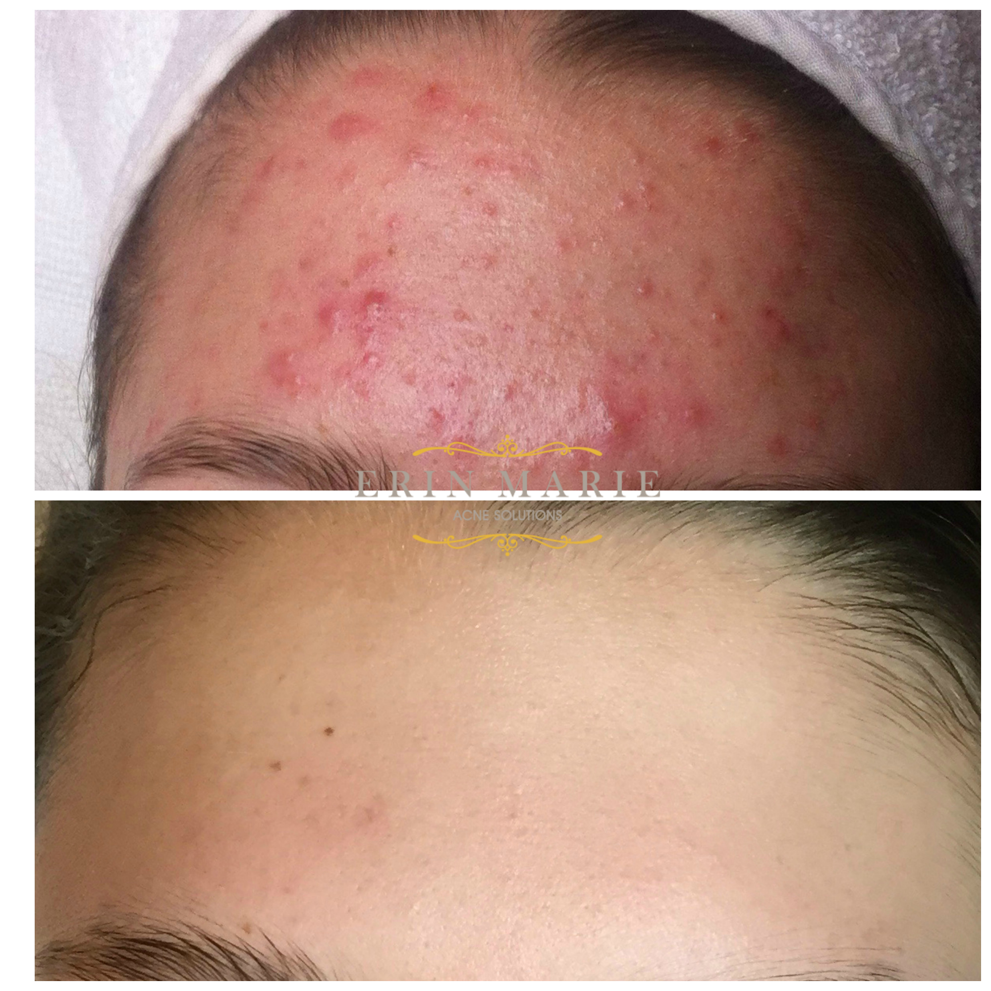 ForeheadB&A.jpg