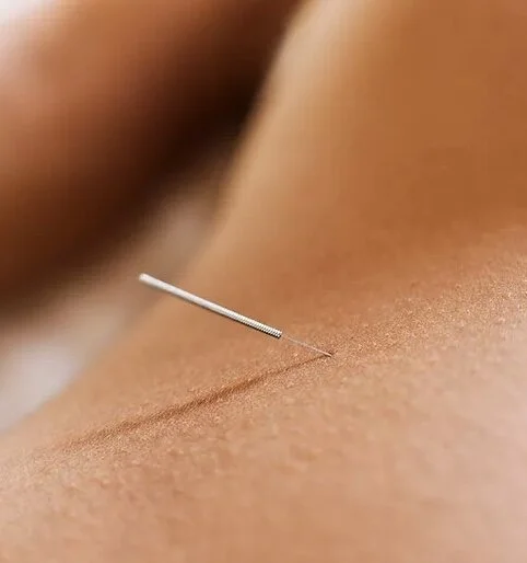 Dry Needling / Intramuscular Stimulation (IMS)​ - Trifecta Rehab