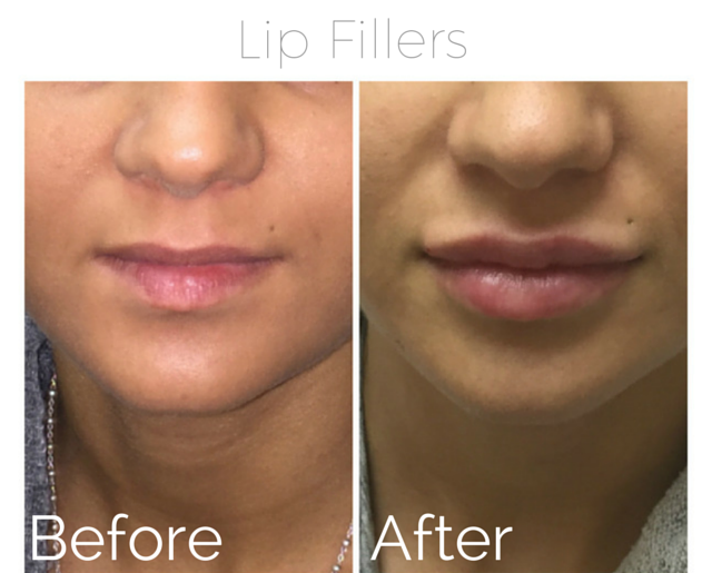 Filler - lips 2.png